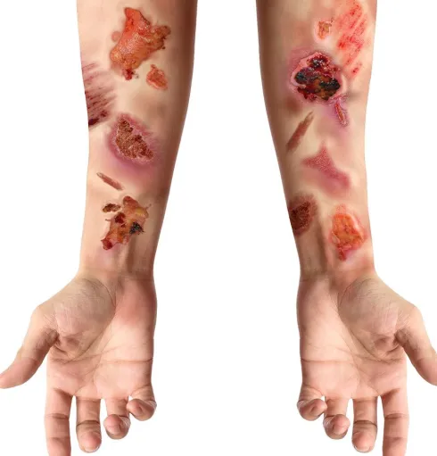 Sår og Ar tattoo - flesh wound